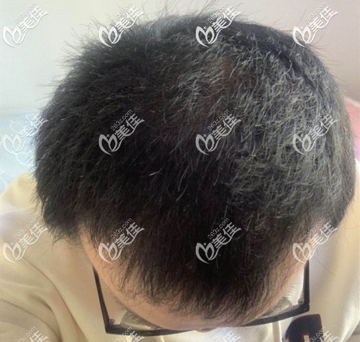 弄清楚头顶脱发是什么原因，还有加密头发需要多少钱后，我在北京薇琳做了植发手术