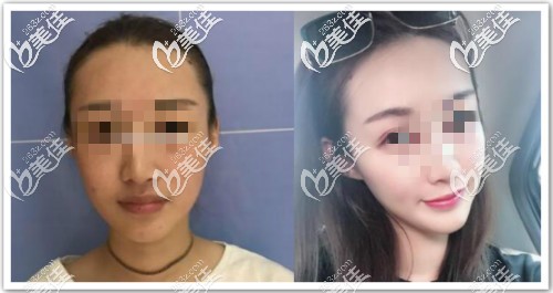 真人案例:八爪鱼面部提升三个月效果对比 真人案例:八爪鱼面部提升三个月效果对比