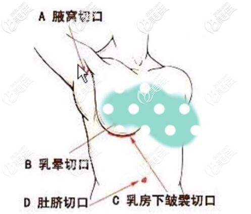 不同切口植入隆胸的疼痛感不一样