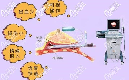 内窥镜隆胸的优势