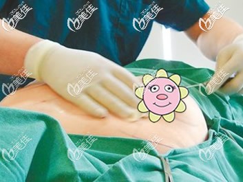 男性乳房抽脂手术流程