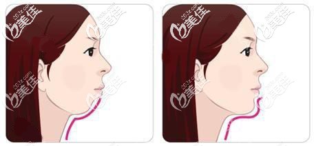 下巴后缩正畸矫正 下巴后缩正畸矫正