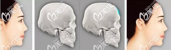 玻尿酸丰额头 玻尿酸丰额头