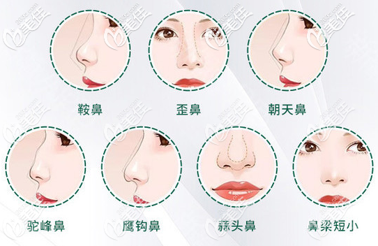 广州星团医美蔡泽翔擅长鼻综合隆鼻