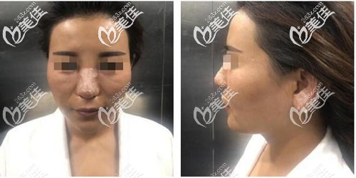 膨体加耳软骨隆鼻恢复期照片