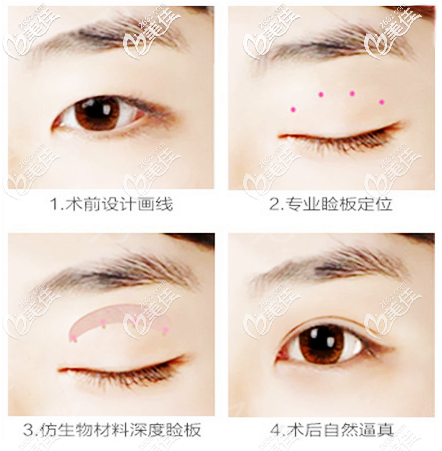 广州星团医美蔡泽翔做色双眼皮案例效果过程图