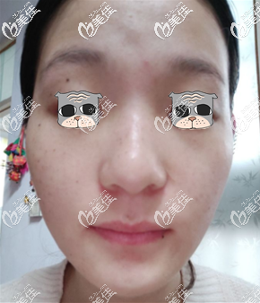 重庆华美皮秒祛斑术后10天图片