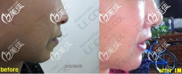 生物肋骨鼻真人案例效果 生物肋骨鼻真人案例效果