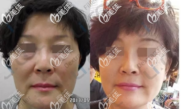 葡聚糖改善面部松弛下垂+去眼袋效果+消除八字纹效果 葡聚糖改善面部松弛下垂+去眼袋效果+消除八字纹效果