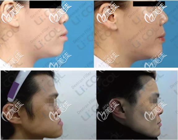 凸嘴地包天的人注射葡聚糖前后对比照片 凸嘴地包天的人注射葡聚糖前后对比照片