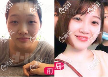 在雅美做双眼皮术前术后对比照 在雅美做双眼皮术前术后对比照