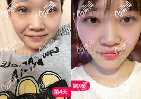 在长沙雅美做双眼皮术后一周左右的效果照 在长沙雅美做双眼皮术后一周左右的效果照