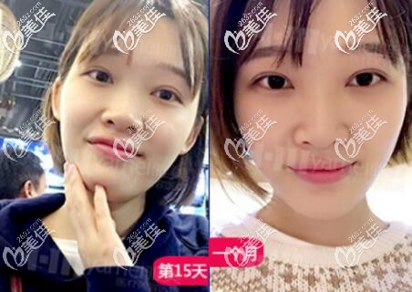 在长沙雅美做双眼皮一个月左右恢复效果照 在长沙雅美做双眼皮一个月左右恢复效果照