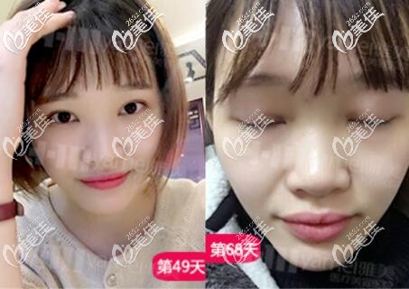 在雅美做双眼皮2个月左右恢复效果图 在雅美做双眼皮2个月左右恢复效果图