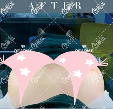 做蓝贝假体丰胸后的即可效果