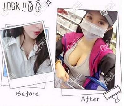 花一万多做蓝贝假体隆胸后我觉得术后效果和手感一点不比进口曼托差
