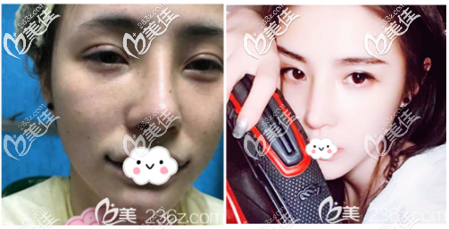 深圳润泽瑞尼丝刘庚自体脂填充案例