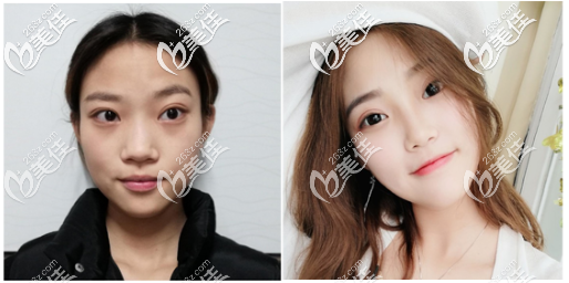 深圳润泽瑞尼丝李忠医生肋软骨隆鼻案例