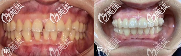 武汉优益佳口腔牙齿矫正真人案例 武汉优益佳口腔牙齿矫正真人案例
