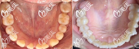 武汉大龄男青年稀疏牙龅牙隐适美整牙之旅,刚开始还觉得价格贵呢