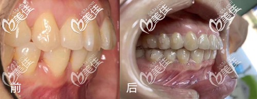 武汉优益佳口腔隐形牙齿矫正案例 武汉优益佳口腔隐形牙齿矫正案例