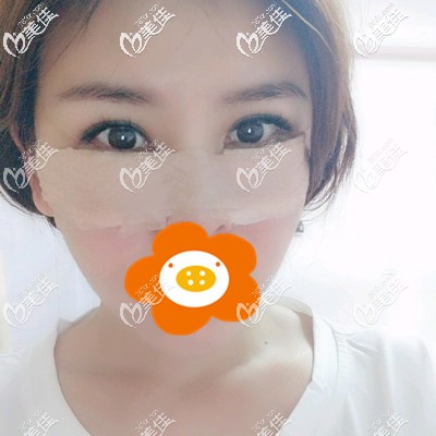 刚做完内切祛眼袋手术的我