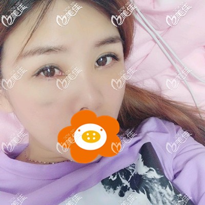 第5天看着消肿了很多