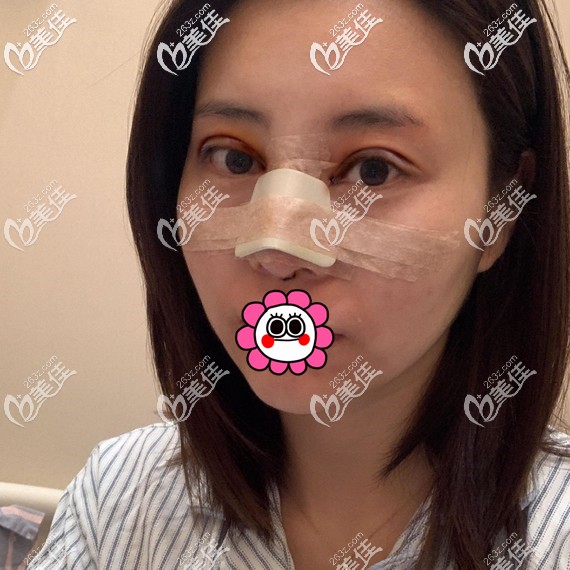双眼皮隆鼻术后即刻