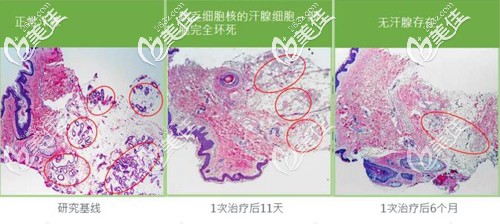 微波去腋臭恢复过程 微波去腋臭恢复过程