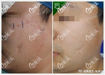 去疤效果怎么样?这些多维祛疤疗法淡化疤痕真实案例给你实锤证据