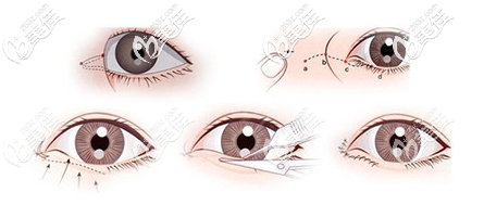 深圳润泽瑞尼丝何海飞医生双眼皮手术过程图