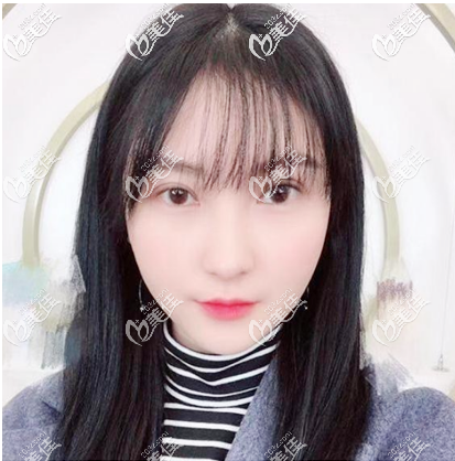 广州美莱哪个医生做眼睛好?看我和闺蜜分别找陈贵宗和刘志坤做的双眼皮效果