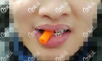 隐形矫正咬胶 隐形矫正咬胶