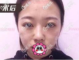 全面部脂肪填充后效果