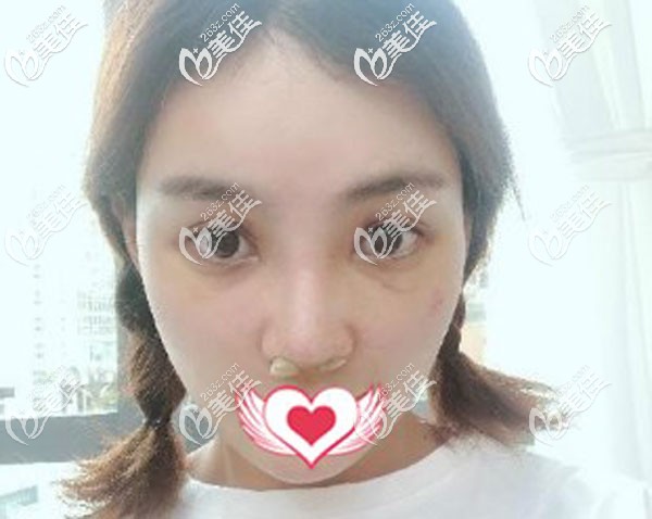 鼻修复手术第7天拆线微肿