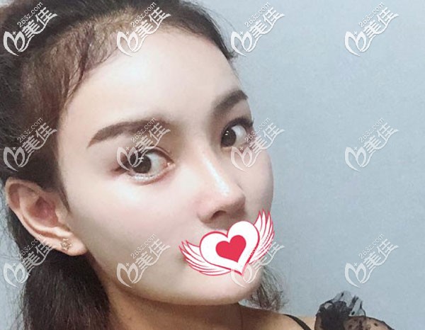 二次鼻修复2个月鼻子看起来很自然