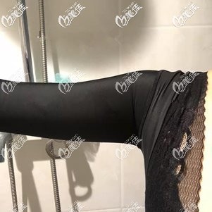 刚做完胳膊吸脂术后穿束身衣