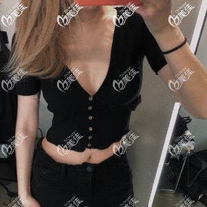 吸脂瘦手臂术后1个月胳膊变细