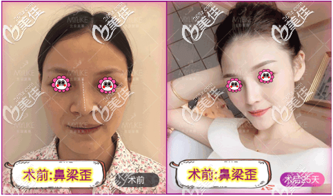 北京美莱牛永敢医生歪鼻矫正案例 北京美莱牛永敢医生歪鼻矫正案例