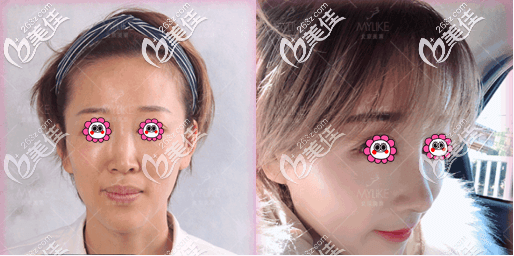 北京美莱牛永敢肋软骨隆鼻修复案例 北京美莱牛永敢肋软骨隆鼻修复案例