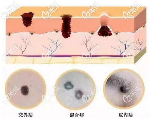 不同痣的情况