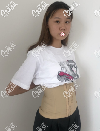我在贵阳美莱做完腰腹吸脂刚一个月 我在贵阳美莱做完腰腹吸脂刚一个月
