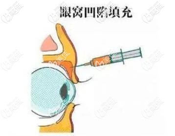 为什么不建议用玻尿酸填充眼窝 为什么不建议用玻尿酸填充眼窝