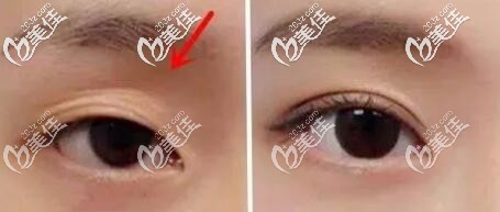 自体脂肪填充眼窝前后对比图片 自体脂肪填充眼窝前后对比图片