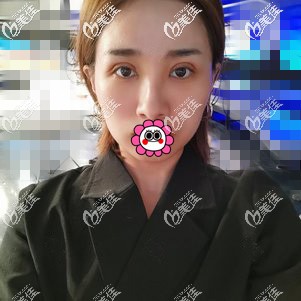 眼修复恢复4天已经消肿