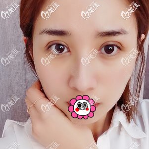 眼部修复恢复一个月效果