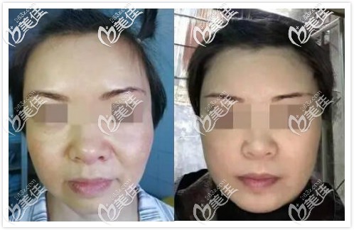 面部五层提升术真人案例效果对比 面部五层提升术真人案例效果对比