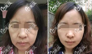 面部五层提升真人案例效果和手术价格分享 面部五层提升真人案例效果和手术价格分享