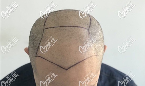 5级脱发种植4000毛囊单位效果示意图 5级脱发种植4000毛囊单位效果示意图