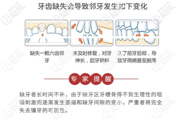 郑医生表示缺牙不修复危害多多 郑医生表示缺牙不修复危害多多